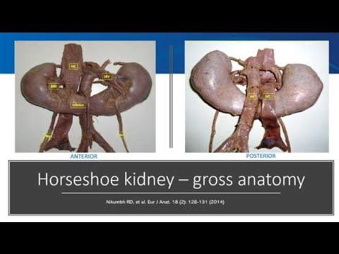 Horseshoe Kidneys: The Unseen Impact on Health & Society