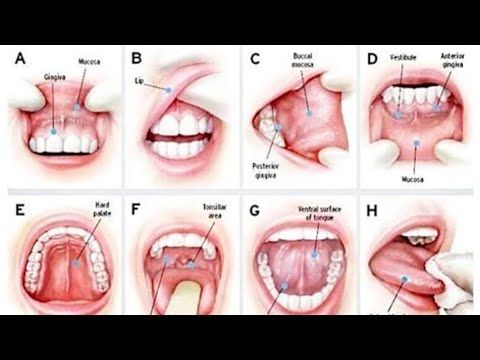 Mouth Cancer: Causes, Signs, & Treatments