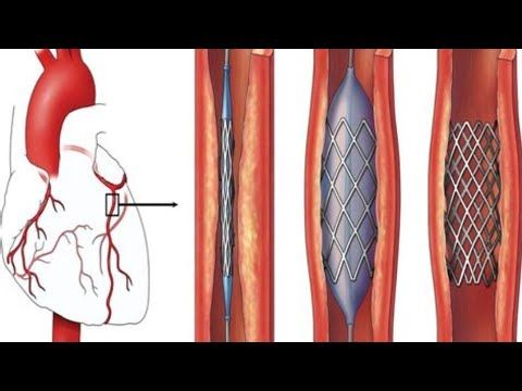 How They Unclog Your Heart (Angioplasty Explained)